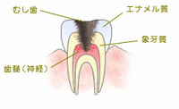 C3：神経まで進行した虫歯